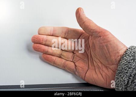 Aspetto palmar della mano destra anziana che mostra il fenomeno di Raynaud nella punta delle dita dell'indice. Foto Stock