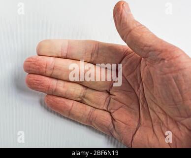 Aspetto palmar della mano destra anziana che mostra il fenomeno di Raynaud nella punta delle dita dell'indice. Foto Stock