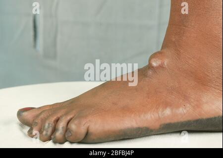 Un paitent con una cisti sebacea sul loro piede. Le cisti sebacee sono cisti non cancerose comuni della pelle. Le cisti sono anomalie nel corpo che ma Foto Stock