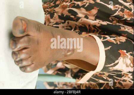 Un paitent con una cisti sebacea sul loro piede. Le cisti sebacee sono cisti non cancerose comuni della pelle. Le cisti sono anomalie nel corpo che ma Foto Stock