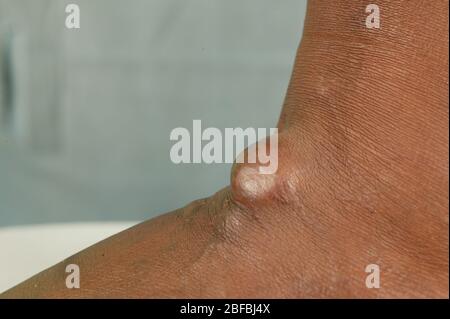 Un paitent con una cisti sebacea sul loro piede. Le cisti sebacee sono cisti non cancerose comuni della pelle. Le cisti sono anomalie nel corpo che ma Foto Stock