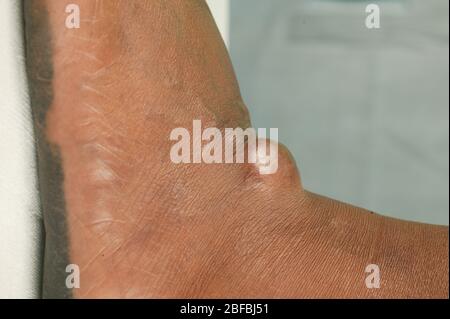 Un paitent con una cisti sebacea sul loro piede. Le cisti sebacee sono cisti non cancerose comuni della pelle. Le cisti sono anomalie nel corpo che ma Foto Stock