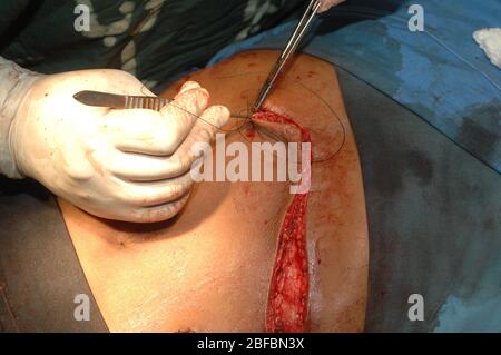 I chirurghi che si cucono hanno chiuso l'area addominale di un paziente dopo una mileenectomia. Foto Stock