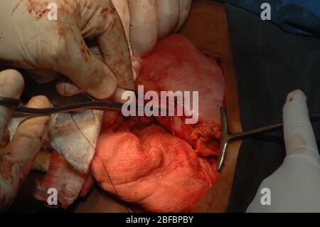 I chirurghi che si cucono hanno chiuso l'area addominale di un paziente dopo una mileenectomia. Foto Stock