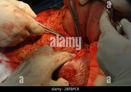 Chirurgo che rimuove una milza ingrossata durante l'intervento chirurgico. Foto Stock
