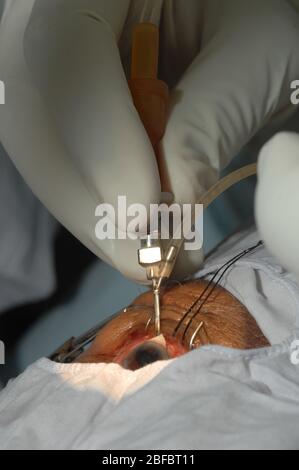 Il manipolo di irrigazione/aspirazione aspira e irriga la camera anteriore, questo viene fatto per liberare parte della corteccia che circonda la lente nu Foto Stock