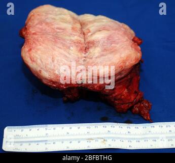 Nella figura è illustrato il tumore appartenente all'uomo sottoposto a chirurgia per rimuovere il fibrosarcoma. Il fibrosarcoma (sarcoma fibroblastico) è un mesenchimale maligno Foto Stock