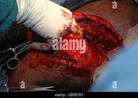 Nella foto è raffigurato un uomo sottoposto a chirurgia per rimuovere il fibrosarcoma. Il fibrosarcoma (sarcoma fibroblastico) è un tumore mesenchimale maligno derivato dal fibrou Foto Stock