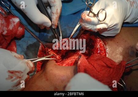 Nella foto è raffigurato un uomo sottoposto a chirurgia per rimuovere il fibrosarcoma. Il fibrosarcoma (sarcoma fibroblastico) è un tumore mesenchimale maligno derivato dal fibrou Foto Stock
