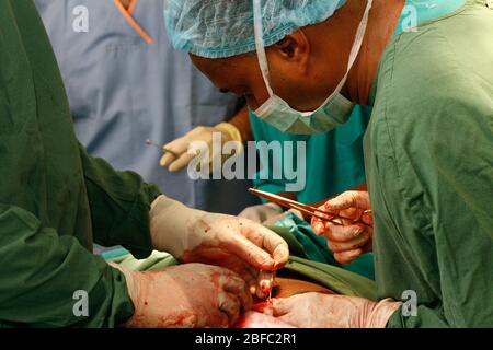 Un chirurgo esegue una sezione cesarea per rimuovere il feto di aborto spontaneo (aborto spontaneo) nell'utero del paziente. Non è noto perché la mota Foto Stock