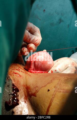 Un chirurgo esegue una sezione cesarea per rimuovere un feto di aborto spontaneo (aborto spontaneo) nell'utero del paziente. Non è noto perché il mo Foto Stock
