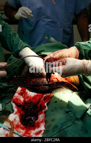 Un chirurgo esegue una sezione cesarea per rimuovere un feto di aborto spontaneo (aborto spontaneo) nell'utero del paziente. Non è noto perché l'attrezzo mot Foto Stock
