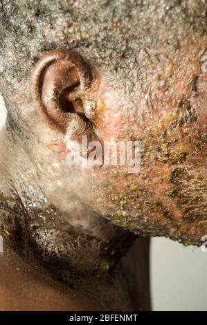 Un giovane che soffre di grave psoriasi ha anche sviluppato una qualche forma di infezione della pelle. Molti pazienti con sintomi dermatologici spesso si manifestano Foto Stock