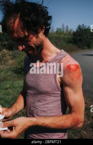 uomo con abrasione su spalla e braccio dopo un incidente di skateboard Foto Stock