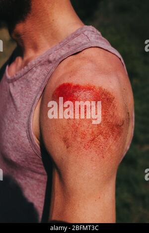 abrasione sulla spalla umana dopo un incidente di skateboard Foto Stock