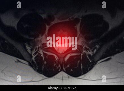 Immagine dopo esame di risonanza magnetica. Concetto di esame della colonna vertebrale, alterazioni degenerative dei dischi intervertebrali, spondilartrosi Foto Stock