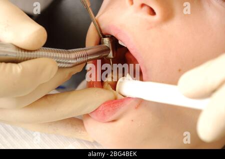 Primo piano di un trapano e di un dispositivo di aspirazione per rimuovere la saliva nella bocca del paziente. Il trapano dentale viene utilizzato per rimuovere la carie e la placca dal Foto Stock