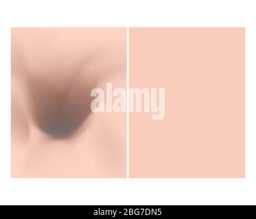 Texture con cicatrici di acne e acne. Prima dopo le cisti cicatriali. Sfondo della pelle. Infografica. Illustrazione vettoriale Illustrazione Vettoriale