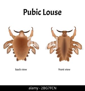 Malattie parassitarie di Phtiriasis. Pediculosi pubis. Struttura di ghiaccio pubico. Malattie sessualmente trasmissibili. Infografiche. Illustrazione del vettore attivata Illustrazione Vettoriale