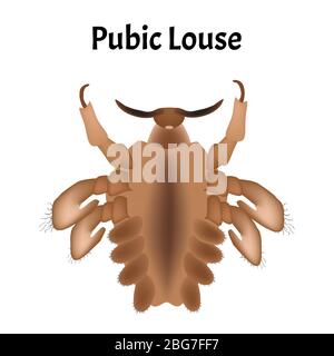 Malattie parassitarie di Phtiriasis. Pediculosi pubis. Struttura di ghiaccio pubico. Malattie sessualmente trasmissibili. Infografiche. Illustrazione del vettore attivata Illustrazione Vettoriale