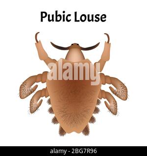 Malattie parassitarie di Phtiriasis. Pediculosi pubis. Struttura di ghiaccio pubico. Malattie sessualmente trasmissibili. Infografiche. Illustrazione del vettore attivata Illustrazione Vettoriale