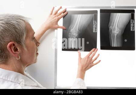 Il radiologo esamina una radiografia del ginocchio su un negatoscopio. Il medico radiogeno vede il legamento sul ginocchio del paziente Foto Stock