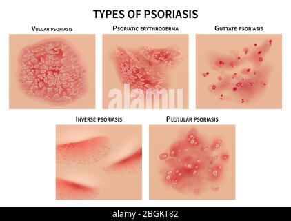 Tipi di psoriasi. Orticaria della pelle, malattie del derma. Illustrazione del vettore medico di primo piano. Allergia dermatologica, prurito e eruzione cutanea medica, sintomo di epidermide Illustrazione Vettoriale