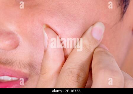 La foto di un uomo asiatico sta schiacciando acne sulla sua faccia. Foto Stock