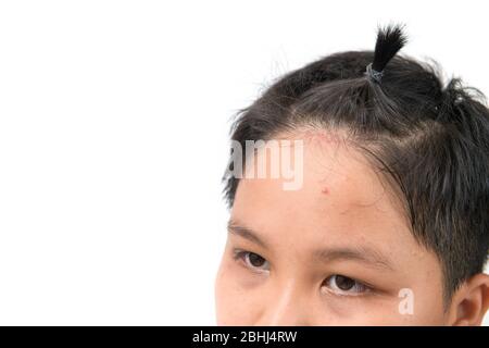 Rash cutaneo e acne sul ragazzo fronte isoalted su sfondo bianco con spazio copia, concetto di cura della salute Foto Stock