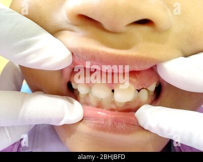 Foto di un ragazzo tailandese con Diastemas problema denti onthe riunito dentale waitng per vedere il dentista in Hua Hin, Thailandia 1 aprile 2018 Foto Stock