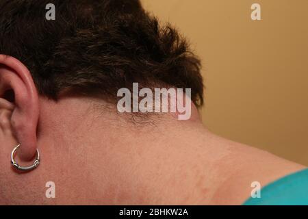 Grande cisti sul retro di un collo mans prima che i medici lo rimuova. Luca Durda/Alamy Foto Stock