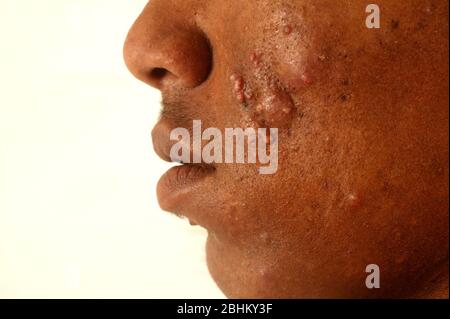 Vista laterale della metà inferiore della faccia di un maschio di 21 anni che soffre di acne vulgaris. L'acne vulgaris è un disordine della pelle che è causato dal blo Foto Stock