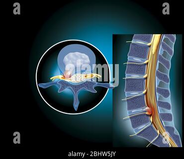 Illustrazione medica che mostra un'erniazione del disco lombare al livello di L4-L5 che comprime i nervi della coda di ponytail. L'erniazione del disco lombare (segue Foto Stock