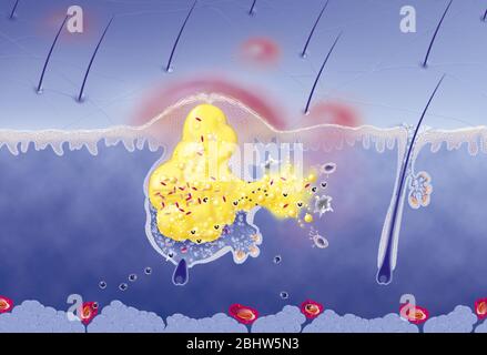 Acne intorno al follicolo dei capelli, ipersecrezione sebacea, ipercheratinizzazione, proliferazione. Sezione cutanea dell'epidermide e del derma. Capelli normali fol Foto Stock