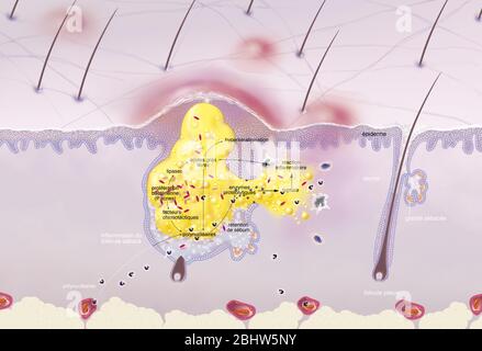 Acne intorno al follicolo dei capelli, ipersecrezione sebacea, ipercheratinizzazione, proliferazione. Sezione cutanea dell'epidermide e del derma. Capelli normali fol Foto Stock
