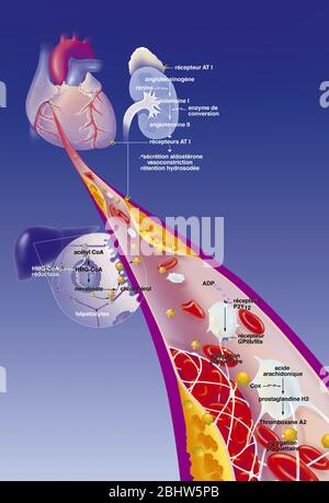 Infarto miocardico, arteria coronaria con trombi, placche ateromatose, trattamenti. Le placche ateromatose (gialle) nella parete della coronaria Foto Stock