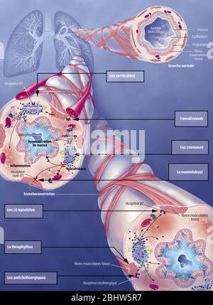 Asma, bronchiolo normale, bronchiolo asmatico con broncocostrizione, ipersecrezione, trattamenti. Rappresentazione dei polmoni con la t bronchiale Foto Stock