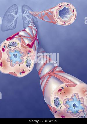 Asma, bronchiolo normale, bronchiolo asmatico con broncocostrizione, ipersecrezione, trattamenti. Rappresentazione dei polmoni con la t bronchiale Foto Stock