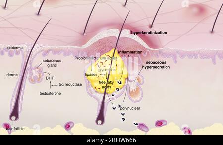 Acne intorno al follicolo dei capelli con infiammazione, ipersecrezione sebacea, ipercheratinizzazione. Sezione cutanea dell'epidermide e del derma. Capelli normali Foto Stock