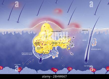 Acne intorno al follicolo dei capelli, ipersecrezione sebacea, ipercheratinizzazione, proliferazione. Sezione cutanea dell'epidermide e del derma. Capelli normali fol Foto Stock