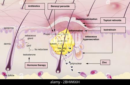 Acne intorno al follicolo dei capelli con infiammazione, ipersecrezione sebacea, ipercheratinizzazione. Sezione cutanea dell'epidermide e del derma. Capelli normali Foto Stock