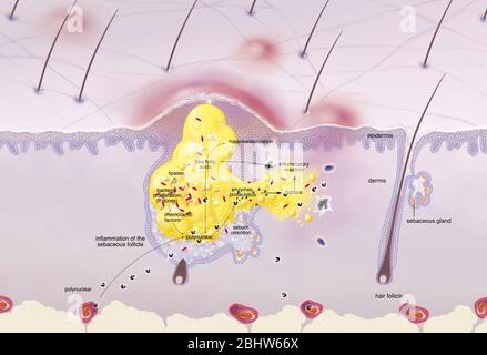 Acne intorno al follicolo dei capelli, ipersecrezione sebacea, ipercheratinizzazione, proliferazione. Sezione cutanea dell'epidermide e del derma. Capelli normali fol Foto Stock