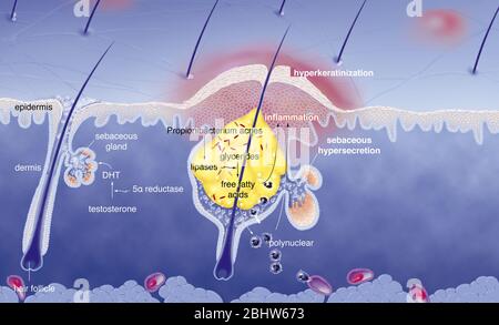 Acne intorno al follicolo dei capelli con infiammazione, ipersecrezione sebacea, ipercheratinizzazione. Sezione cutanea dell'epidermide e del derma. Capelli normali Foto Stock