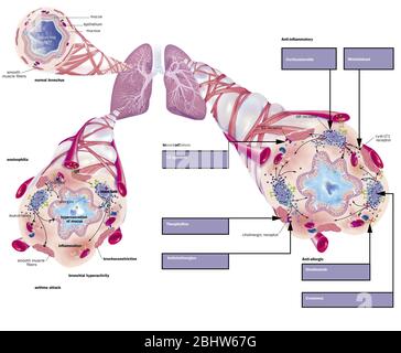 Asma, bronchiolo normale, bronchiolo asmatico con broncocostrizione, ipersecrezione, trattamenti. Rappresentazione dei polmoni con la t bronchiale Foto Stock