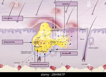 Acne intorno al follicolo dei capelli, ipersecrezione sebacea, ipercheratinizzazione, proliferazione. Sezione cutanea dell'epidermide e del derma. Capelli normali fol Foto Stock