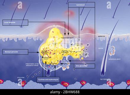 Acne intorno al follicolo dei capelli, ipersecrezione sebacea, ipercheratinizzazione, proliferazione. Sezione cutanea dell'epidermide e del derma. Capelli normali fol Foto Stock