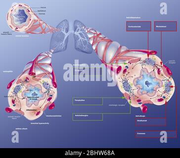 Asma, bronchiolo normale, bronchiolo asmatico con broncocostrizione, ipersecrezione, trattamenti. Rappresentazione dei polmoni con la t bronchiale Foto Stock