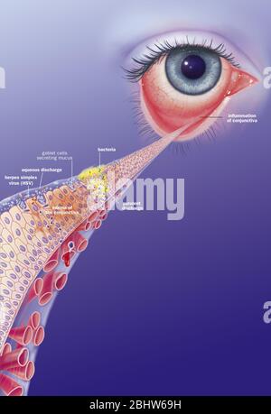 Congiuntivite infettiva e suoi trattamenti. Vista di un occhio con infiammazione della congiuntiva. Zoom sulla congiuntiva con dall'alto verso il basso 1 b Foto Stock