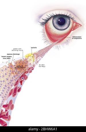 Congiuntivite infettiva e suoi trattamenti. Vista di un occhio con infiammazione della congiuntiva. Zoom sulla congiuntiva con dall'alto verso il basso 1 b Foto Stock
