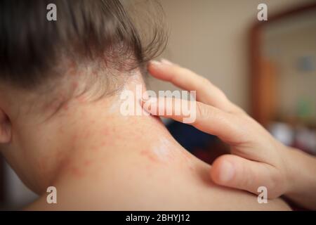 Le mani della donna lubrificano la pelle danneggiata sul collo con unguento healing, concetto di sanità Foto Stock